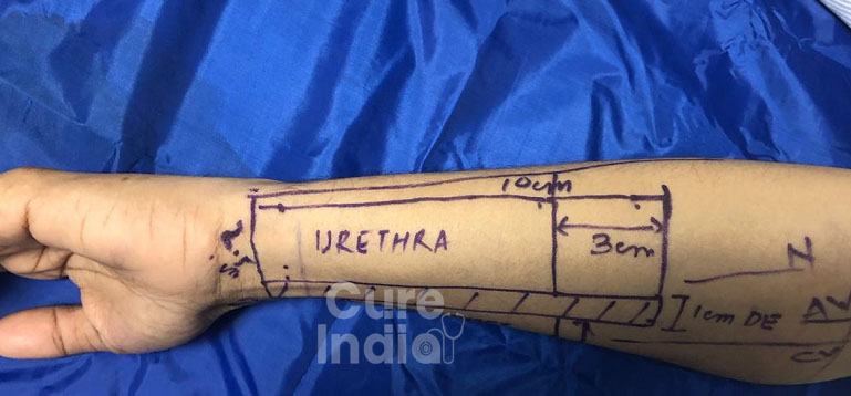عملية تحويل الجنس من الانثى الى ذكر في الهند مع افضل طب
