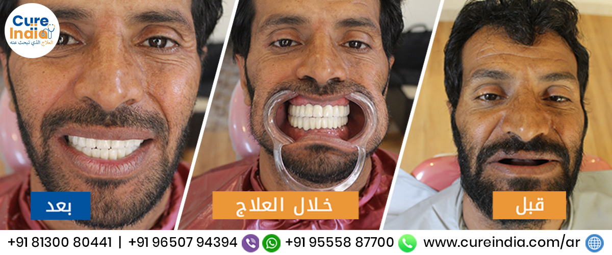 زراعة الاسنان في الهند بارخص الاسعار في افضل عيادة الا