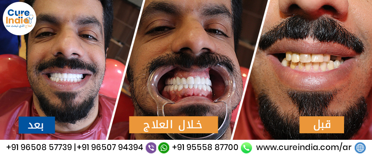 تلبيس الاسنان في افضل عيادة لتيجان الاسنان في الهند