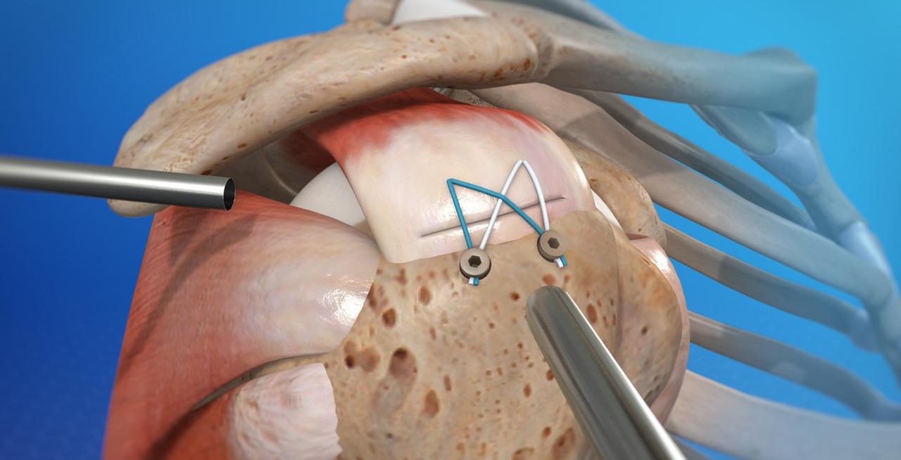 Артроскопический Ремонт Вращающей Манжеты Плеча в Индии