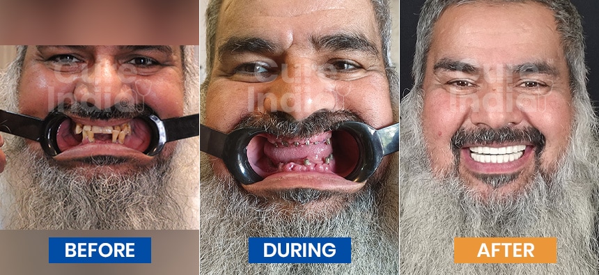 Dental implant before after photos-2