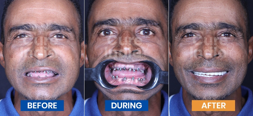 Dental implant before after photos-1
