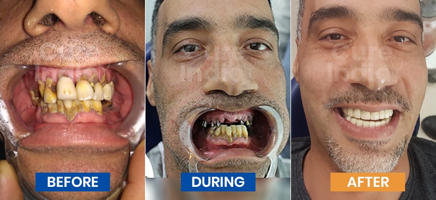 Dental implant before after photos-3