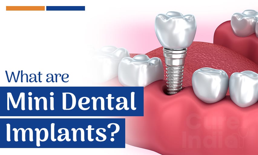What are Mini Dental Implants and Their Benefits?