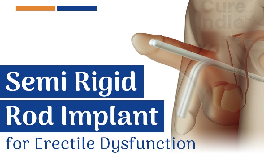 Top 5 Semi Rigid Rod Implant for Erectile Dysfunction