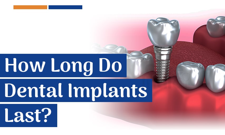 How Long Do Dental Implants Last?