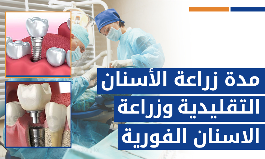 مدة زراعة الأسنان التقليدية وزراعة الاسنان الفورية