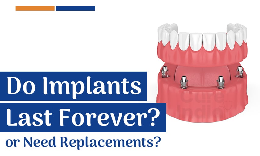 Do dental implants last forever or need replacements?