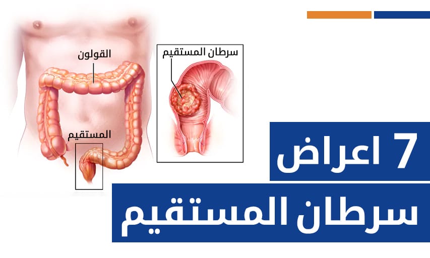 ٧ اعراض سرطان المستقيم يجب الانتباه لها