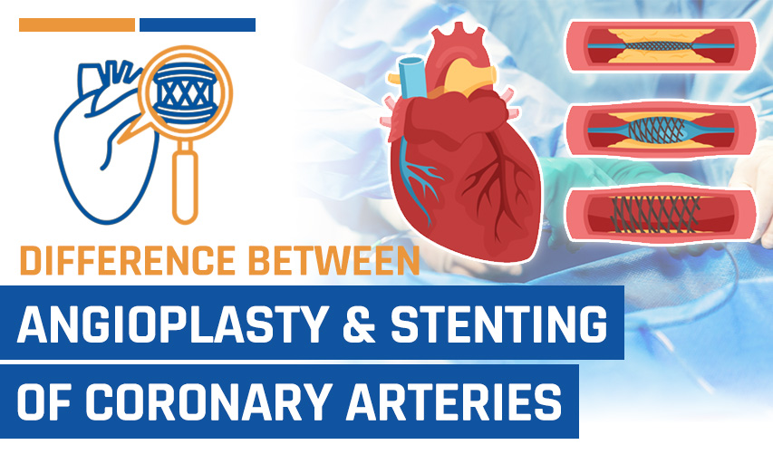 What is the Difference Between Angioplasty and Stenting of Coronary Arteries?