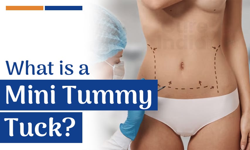 What is a Mini Tummy Tuck and How it is Different from a Tummy Tuck