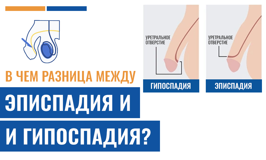 В чем разница между эписпадия и гипоспадия?