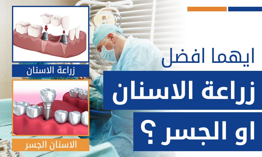ايهما افضل زراعة الاسنان او الجسر؟
