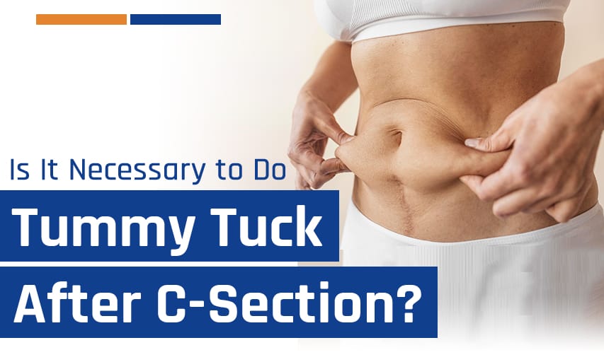 Is It Necessary to Do Tummy Tuck After C-Section?