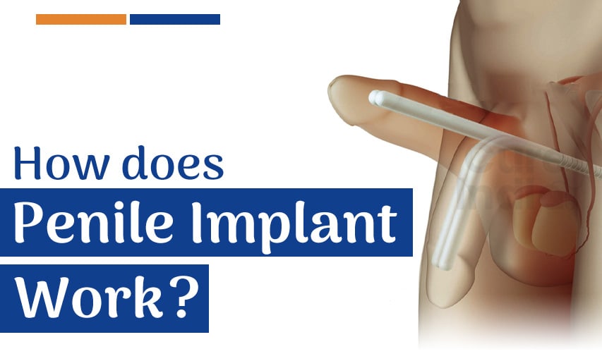 How Does a Penile Implant Work?