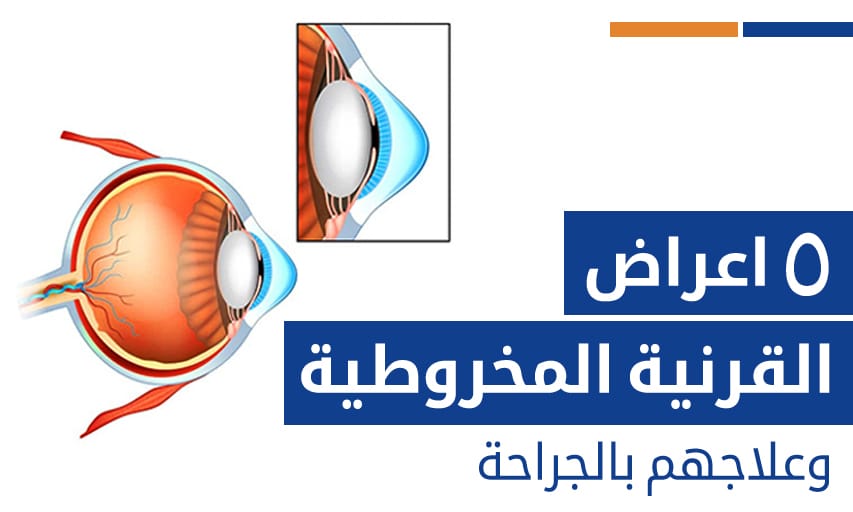 ٥ اعراض القرنية المخروطية وعلاجهم بالجراحة