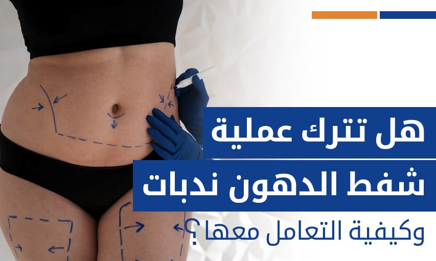 هل تترك عملية شفط الدهون ندبات وكيفية التعامل معها؟