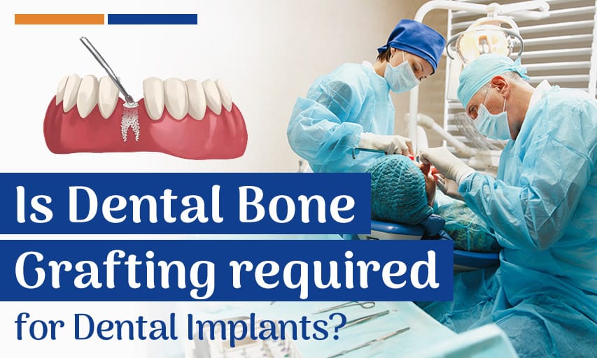 Why is Dental Bone Grafting required for Dental Implants?
