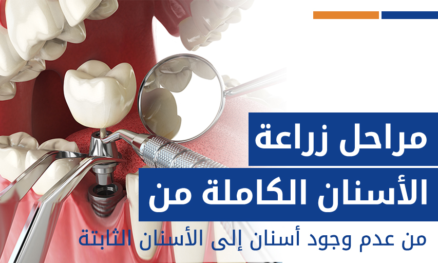 مراحل زراعة الأسنان الكاملة من عدم وجود أسنان إلى الأسنان الثابتة