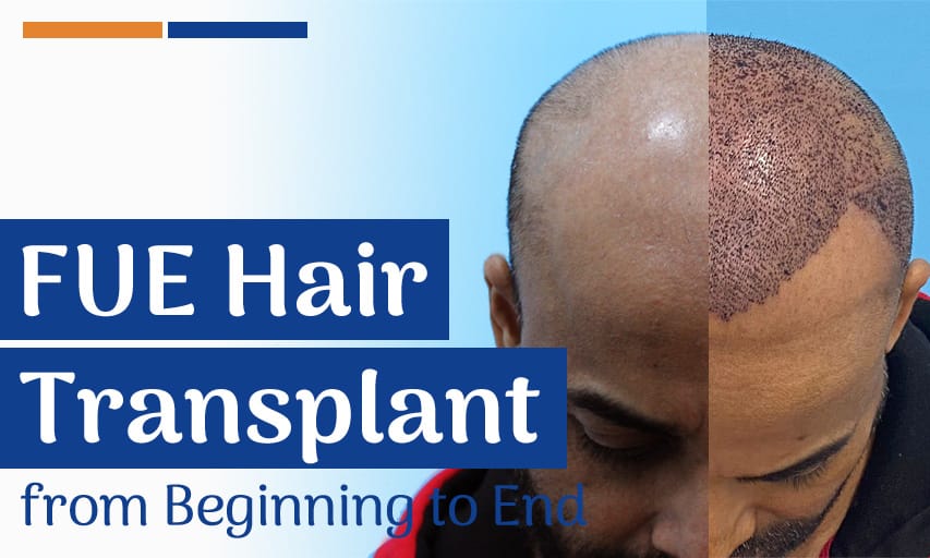 FUE Hair Transplant Procedure from Beginning to End