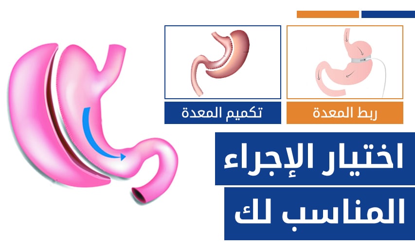 ربط المعدة بالمنظار مقابل. تكميم المعدة - اختيار الإجراء المناسب لك