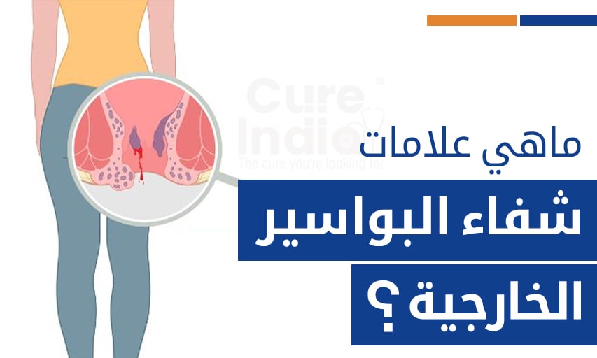 ماهي علامات شفاء البواسير الخارجية؟
