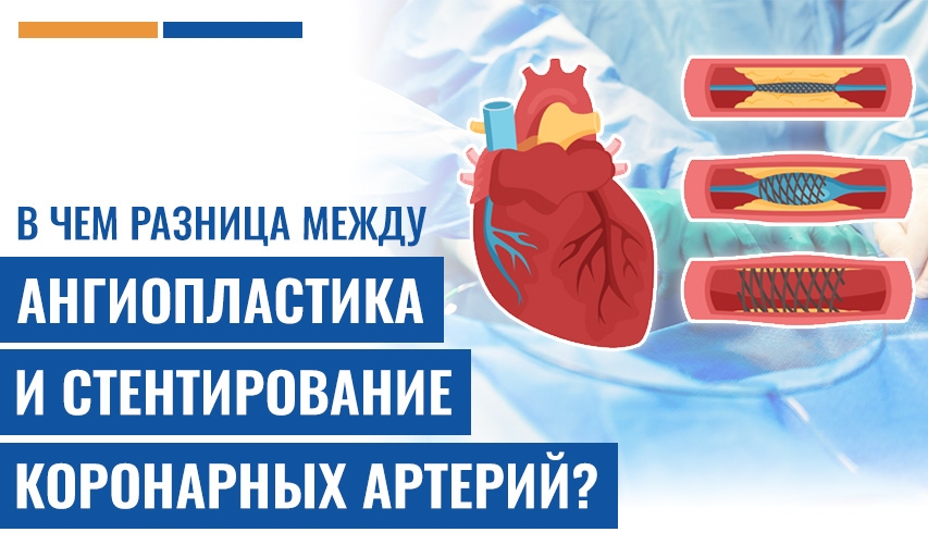 В Чем Разница Между Ангиопластика И Стентирование Коронарных Артерий?