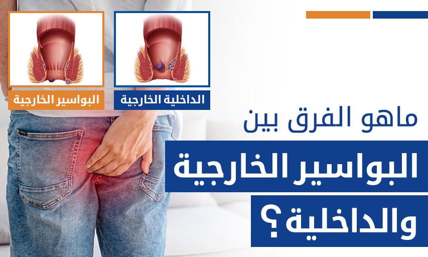 ماهو الفرق بين البواسير الخارجية والداخلية؟