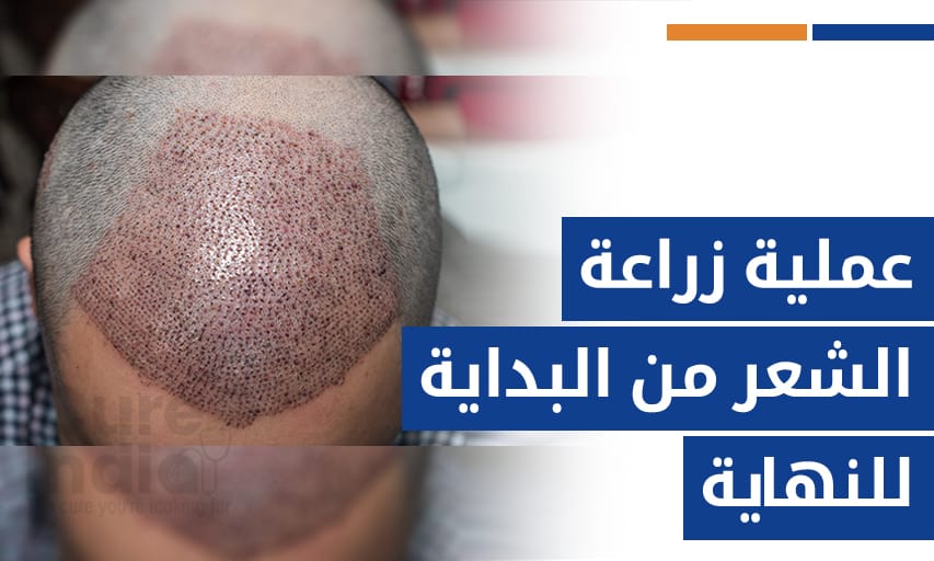 عملية زراعة الشعر من البداية للنهاية