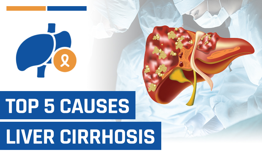5 Liver Cirrhosis Causes That May Lead to a Liver Transplant