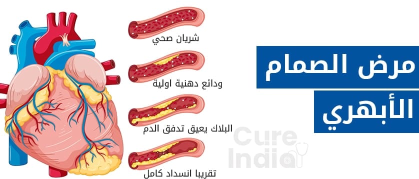 عملية-صمام-القلب-في-الهند