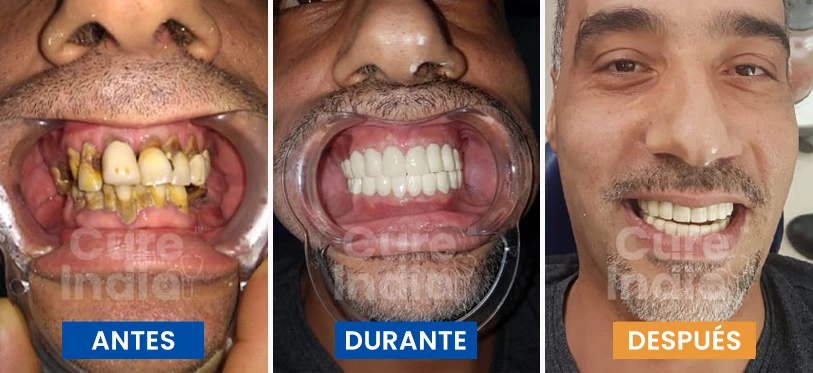 implantes-dentales-antes-y-después-caso-1