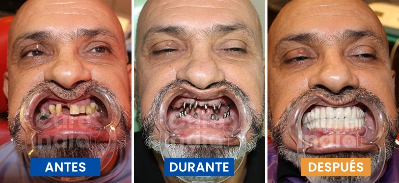 implantes-dentales-antes-y-después-caso-2