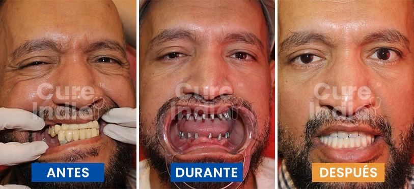 implantes-dentales-antes-y-después-caso-3