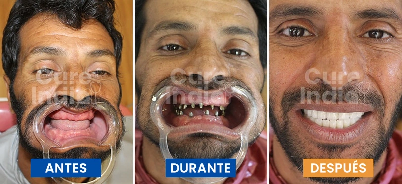 implantes-dentales-antes-y-después-caso-4