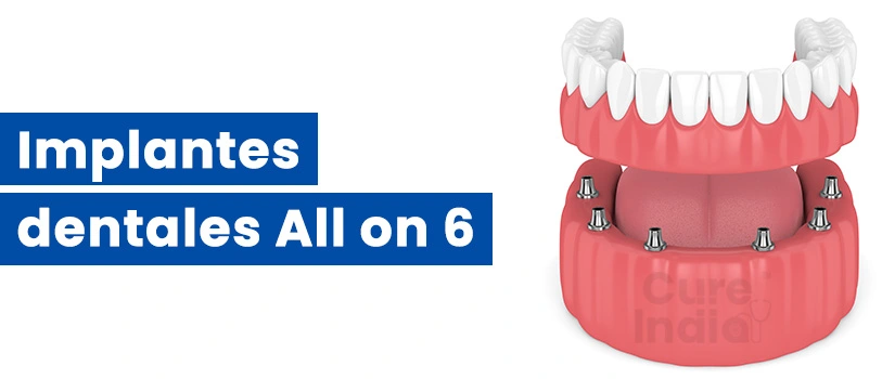 implantes-dentales-all-on-6-de-boca-completa
