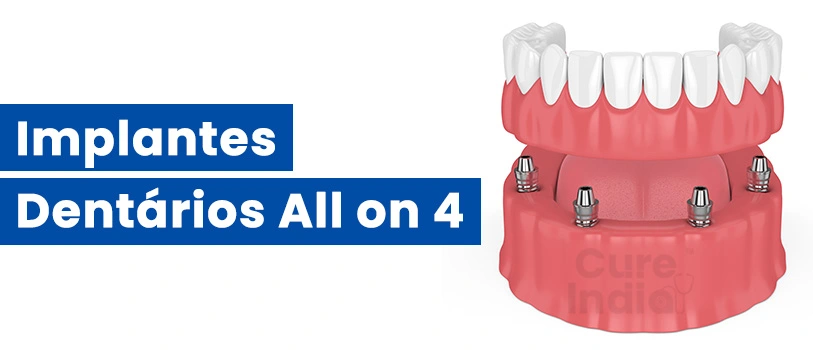implantes-dentários-all-on-4