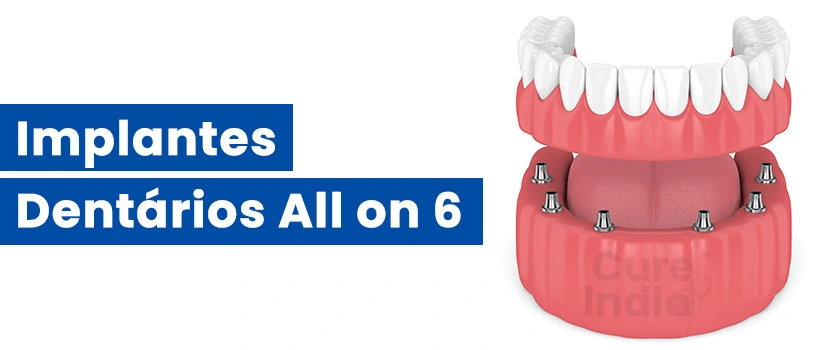 implantes-dentários-all-on-6