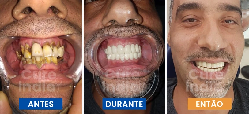 implantes-dentários-antes-e-depois-caso-1