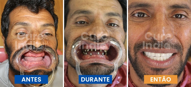 implantes-dentários-antes-e-depois-caso-5