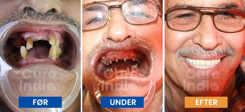 planlægge-dine-tandimplantater-for-hele-munden-i-Indien