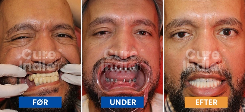 tandimplantater-før-og-efter-sag-4