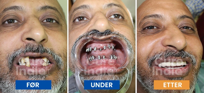 tannimplantater-før-og-etter-sak-3
