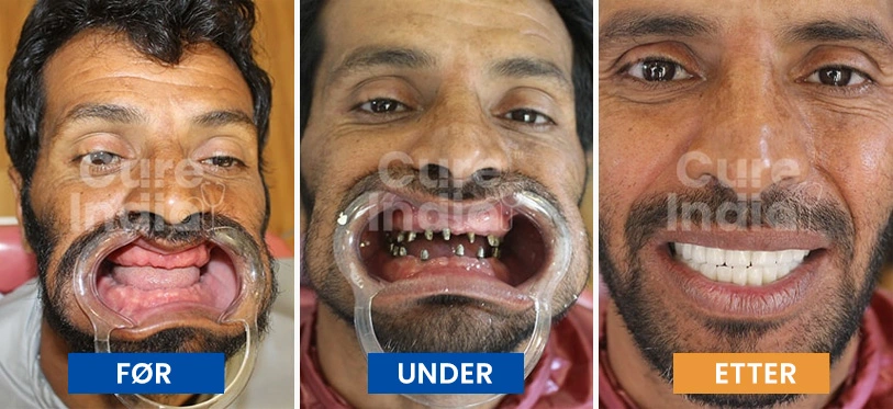 tannimplantater-før-og-etter-sak-5