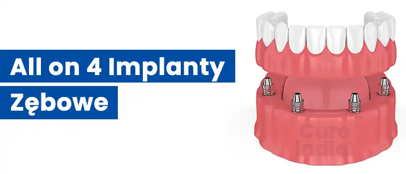 all-on-4-implanty-zębowe