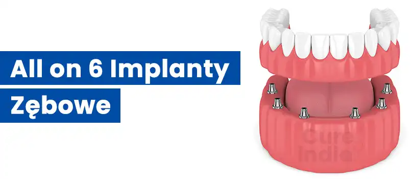 all-on-6-implanty-zębowe