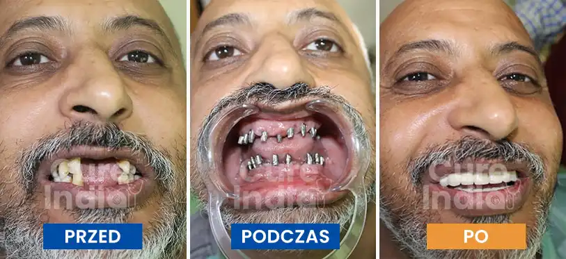 implanty-zębowe-przed-i-po-3