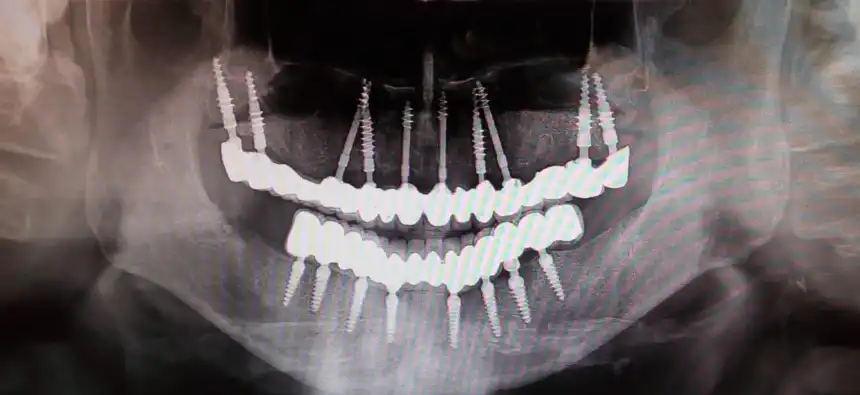 implanty-zębowe-z-natychmiastowym-obciążeniem