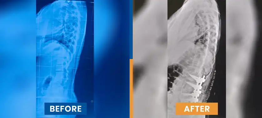 scoliosis-surgery-in-india-before-after-case-3