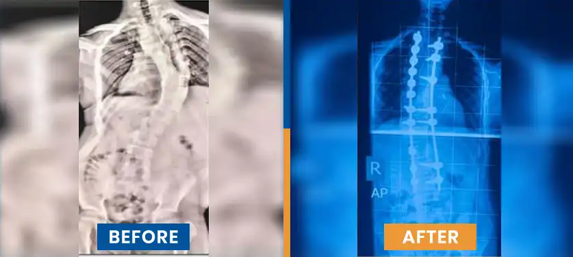 scoliosis-treatment-in-india-before-after-case-2